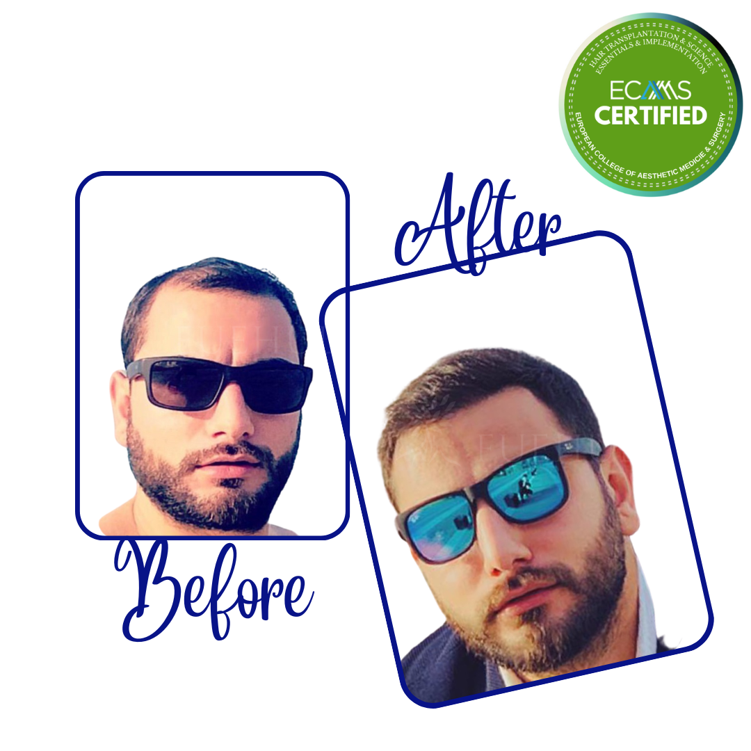 Case 07 before-and-after composite showing frontal hairline and temple restoration at FUEHUB Cyprus.