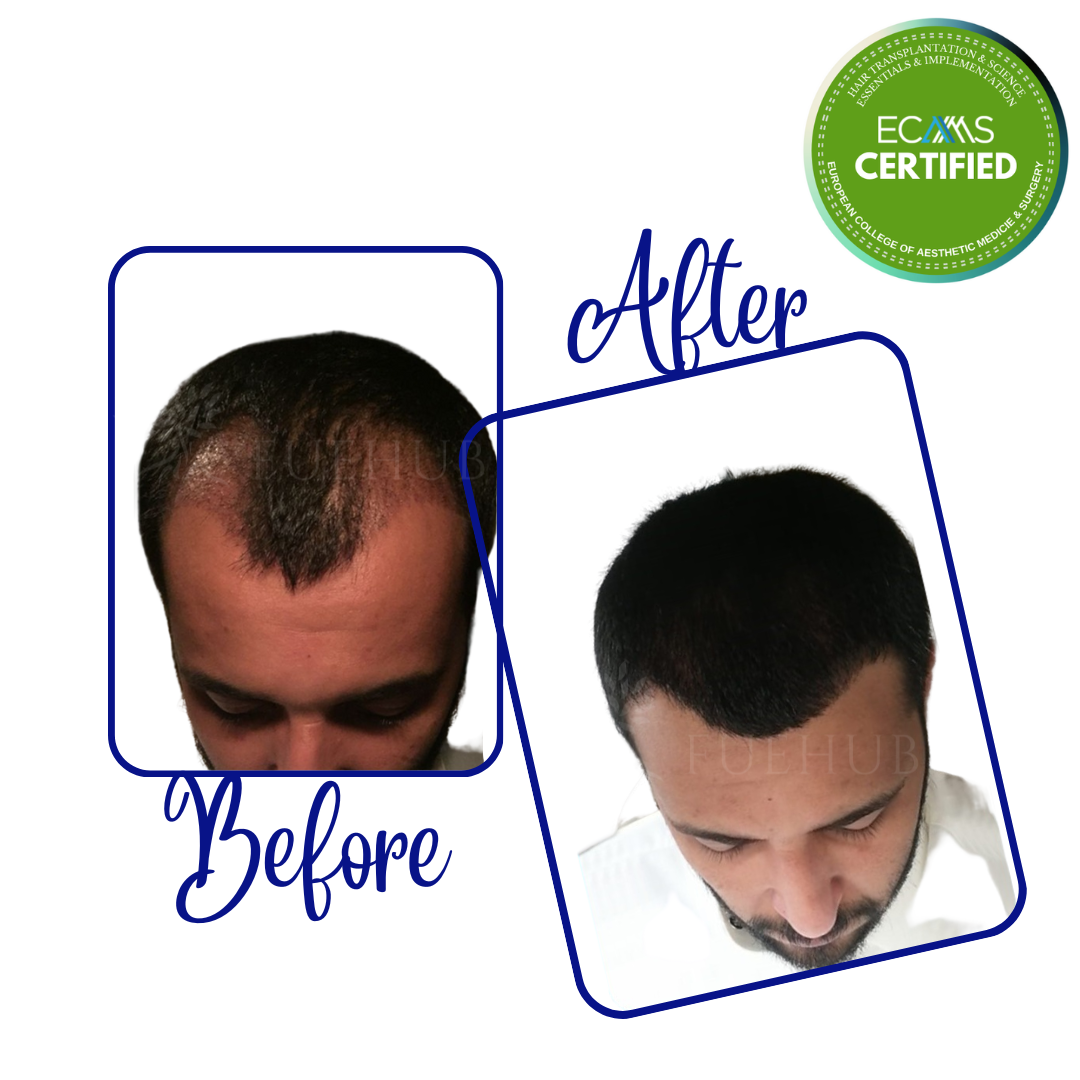 Case 06 before-and-after composite showing frontal and mid-scalp restoration at FUEHUB Cyprus.