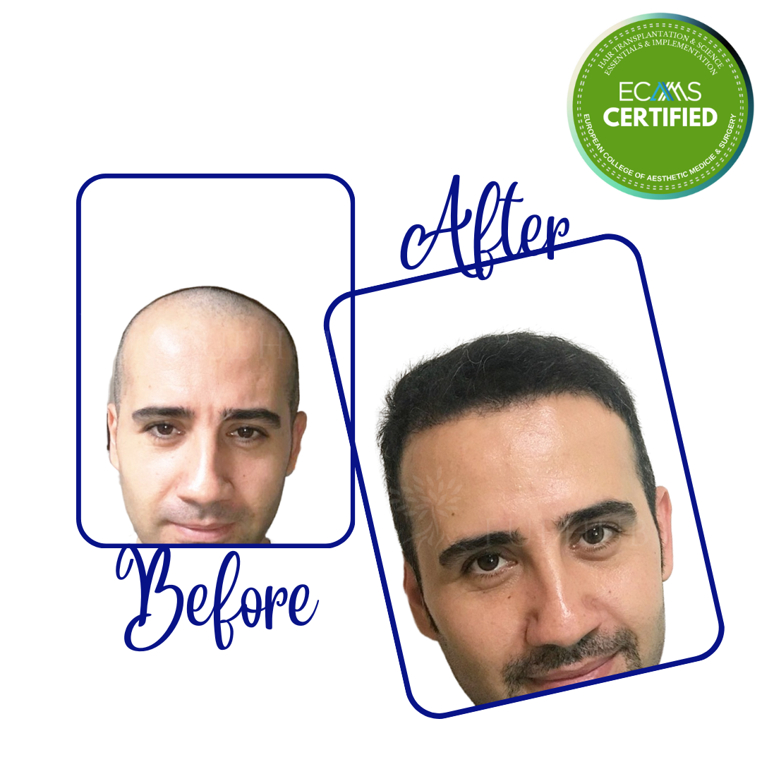 Case 10 before-and-after composite showing frontal-zone restoration at FUEHUB Cyprus.