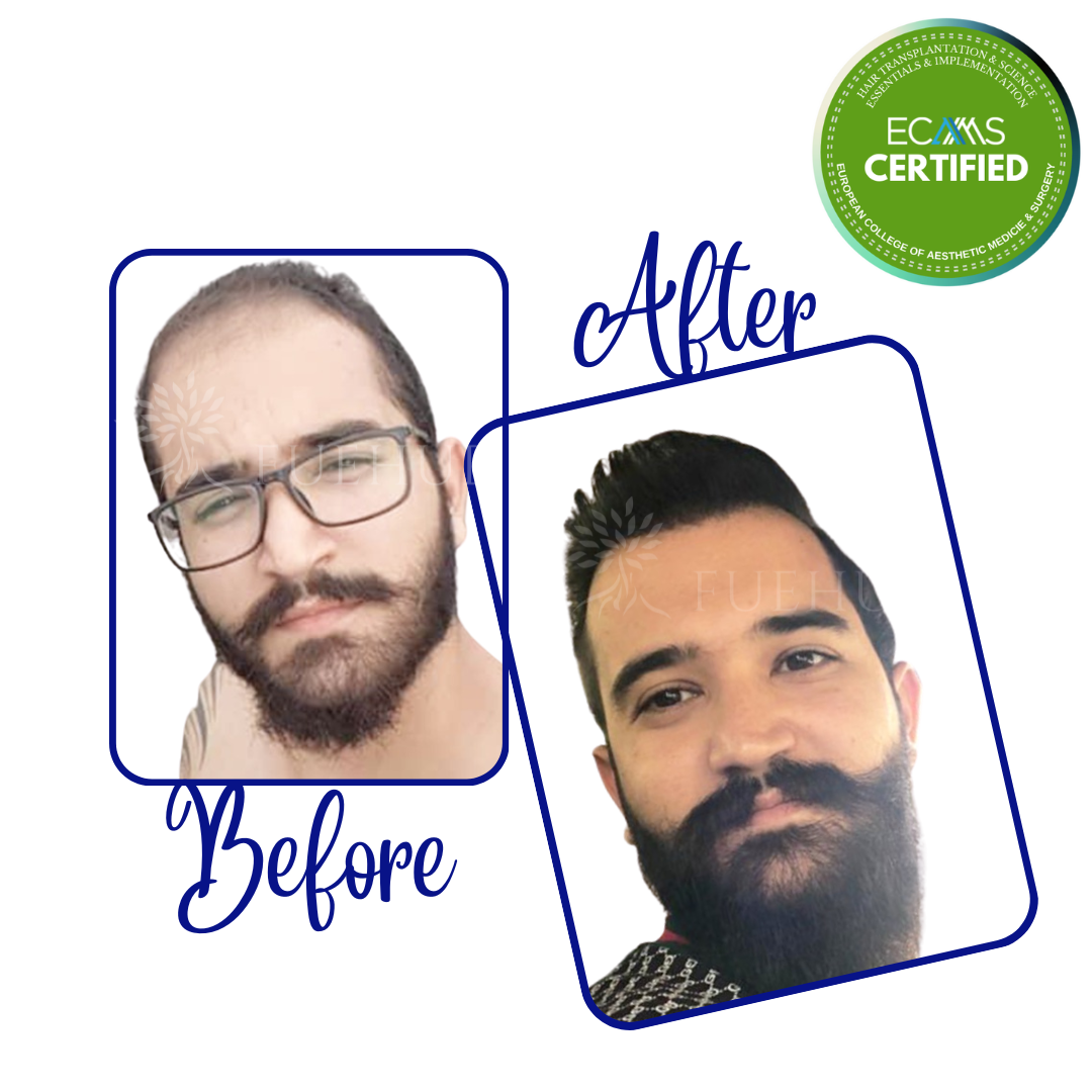 Case 05 before-and-after composite showing frontal-zone and hairline restoration at FUEHUB Cyprus.