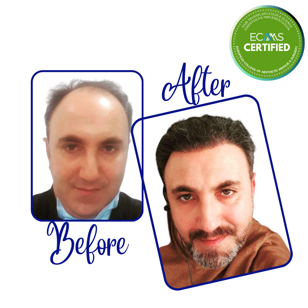 Case 09 before-and-after composite showing frontal hairline and temple restoration at FUEHUB Cyprus.