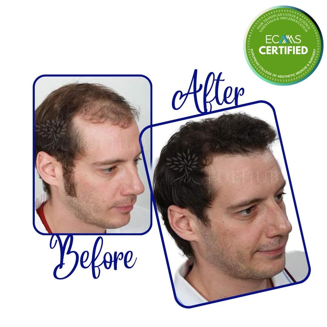 Case 01 before-and-after composite showing frontal hairline and frontal zone at FUEHUB Cyprus.