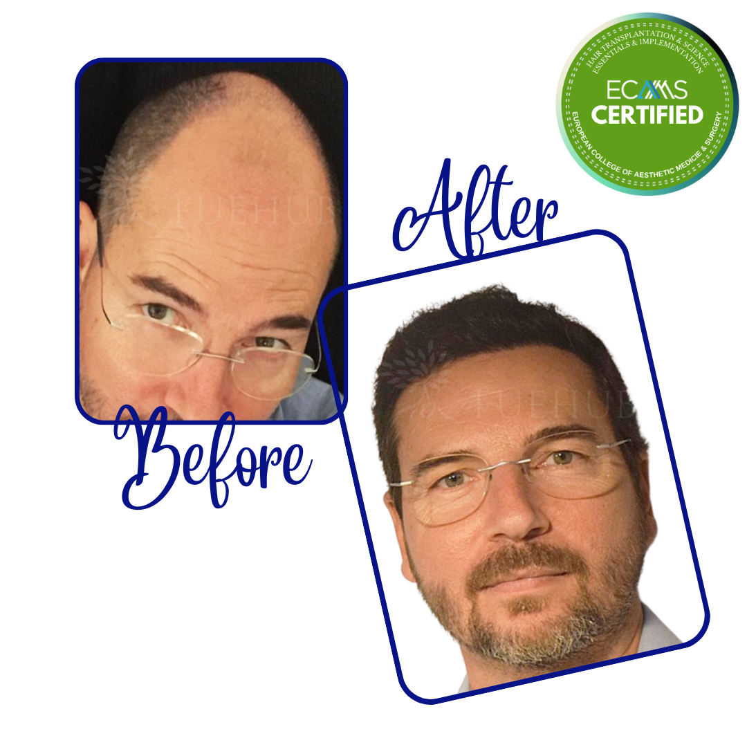 Case 08 before-and-after composite showing advanced frontal and mid-scalp restoration at FUEHUB Cyprus.