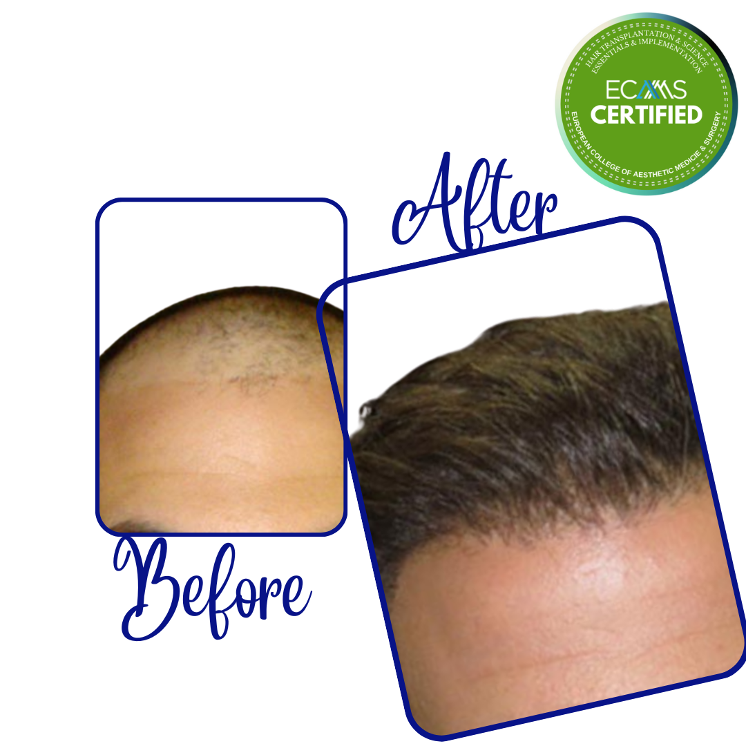 Case 15 before-and-after composite showing frontal-zone and hairline restoration at FUEHUB Cyprus.