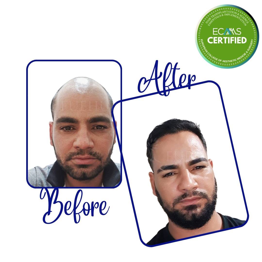 Case 13 before-and-after composite showing frontal hairline and temple restoration at FUEHUB Cyprus.