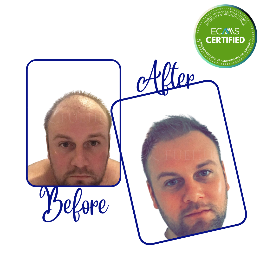 Case 02 before-and-after composite showing frontal and mid-scalp restoration at FUEHUB Cyprus.