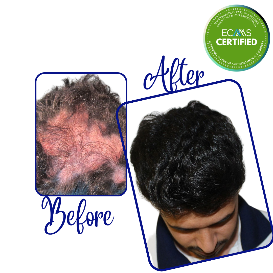 Case 18 before-and-after composite showing crown and vertex restoration at FUEHUB Cyprus.