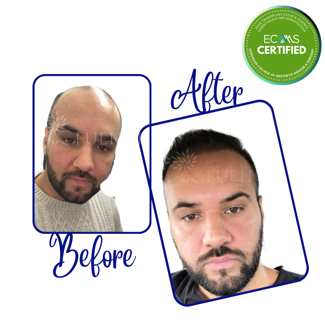 Case 21 before-and-after composite showing frontal-zone and hairline restoration at FUEHUB Cyprus.
