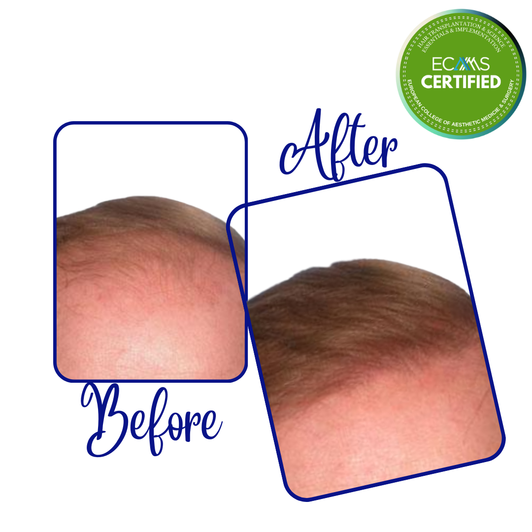 Case 12 before-and-after composite showing frontal hairline refinement at FUEHUB Cyprus.