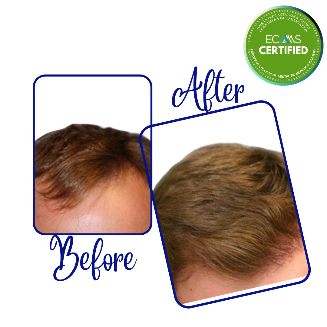 Case 16 before-and-after composite showing frontal density and hairline restoration at FUEHUB Cyprus.