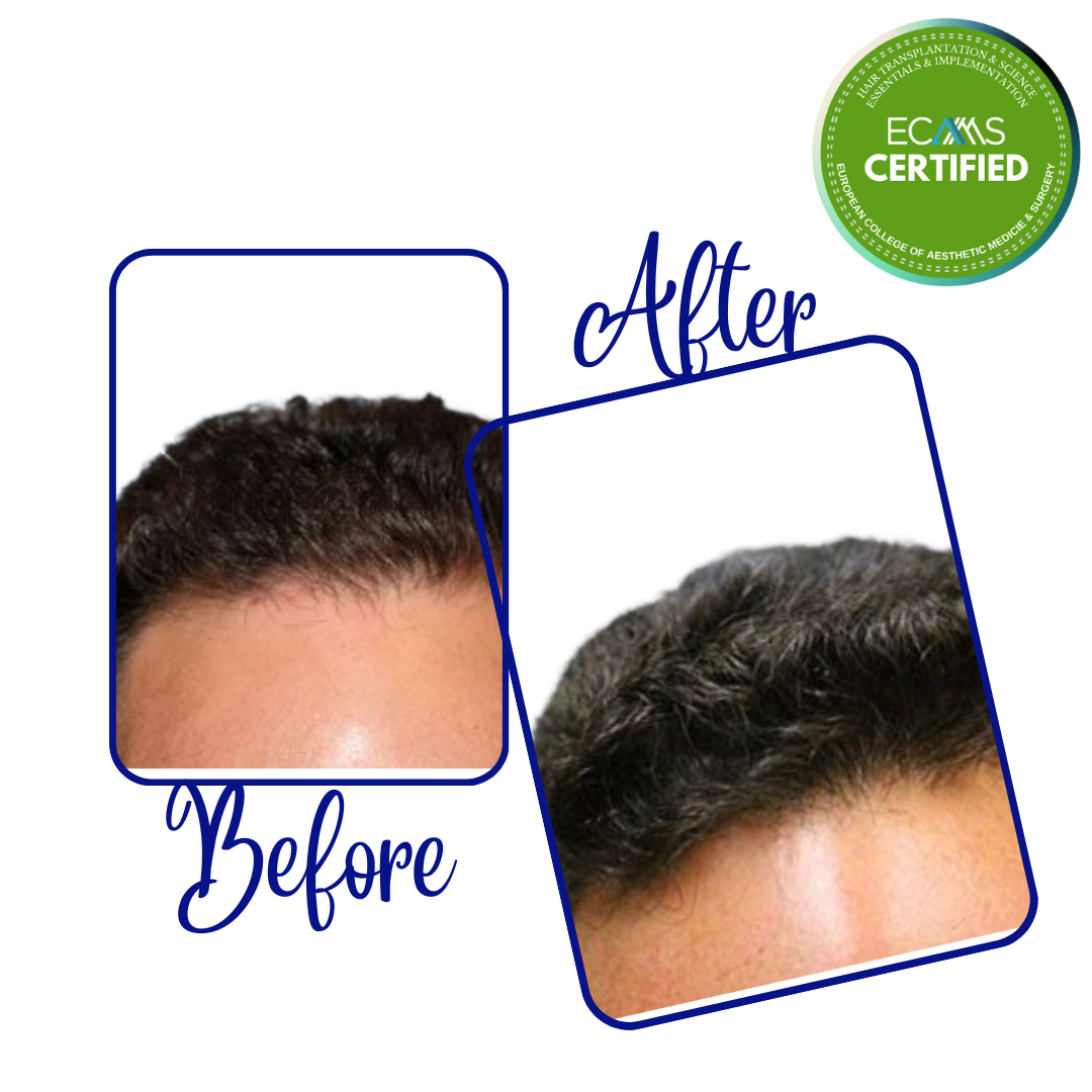 Case 17 before-and-after composite showing frontal hairline refinement at FUEHUB Cyprus.