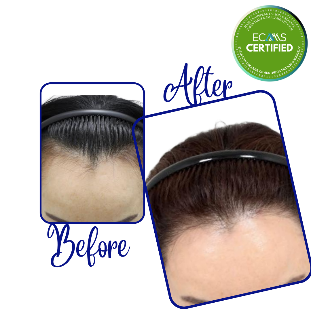 Case 25 before-and-after composite showing female frontal-temporal hairline restoration at FUEHUB Cyprus.