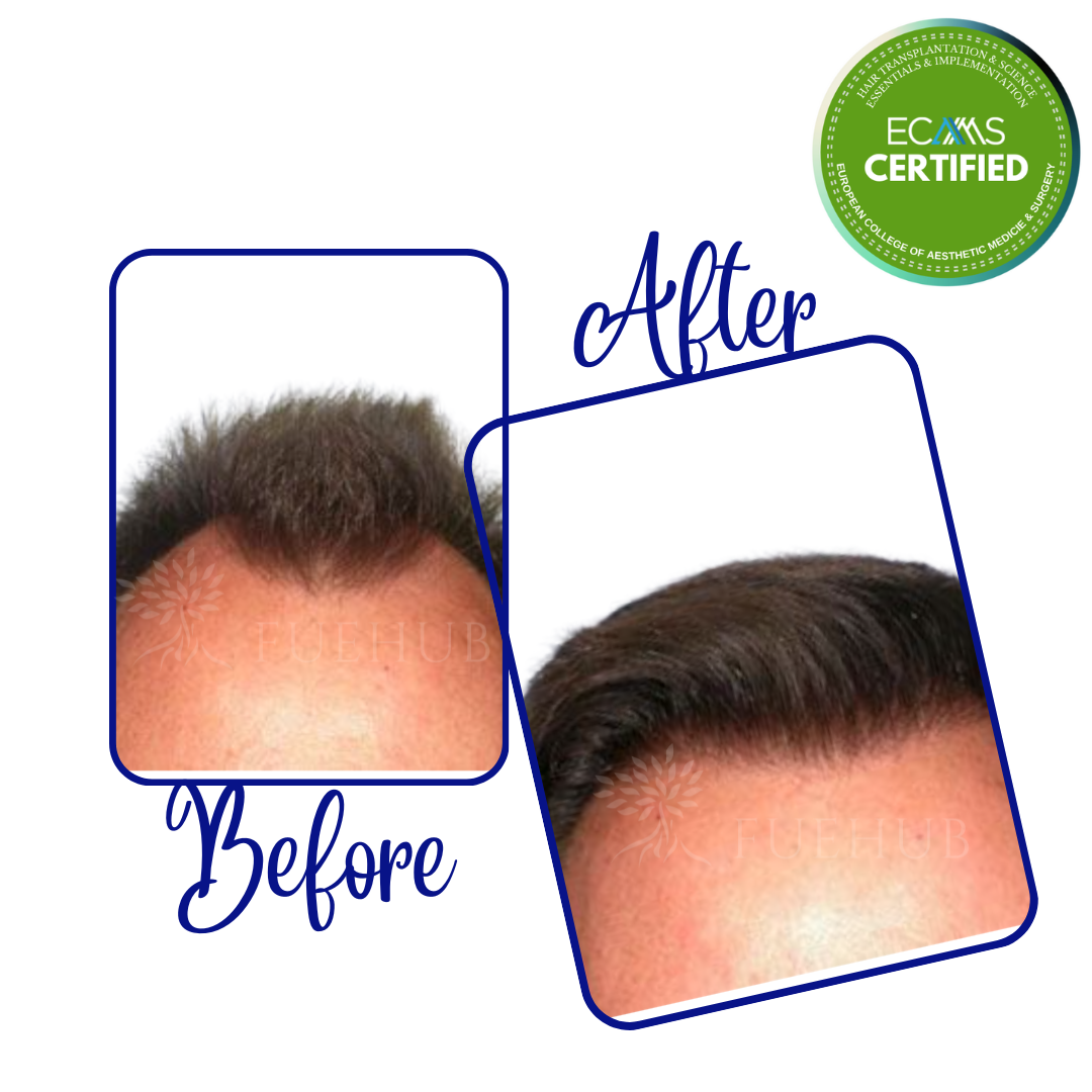 Case 14 before-and-after composite showing frontal hairline refinement at FUEHUB Cyprus.