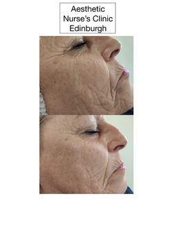 Firming and lifting peeling