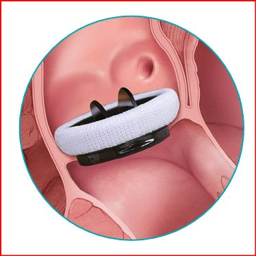 Искуственный клапан сердца