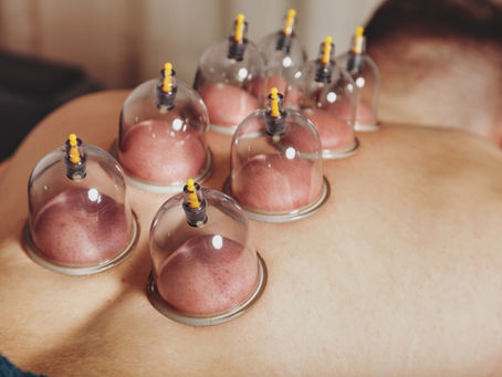 cupping therapy