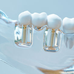 Couronnes et bridges sur implants