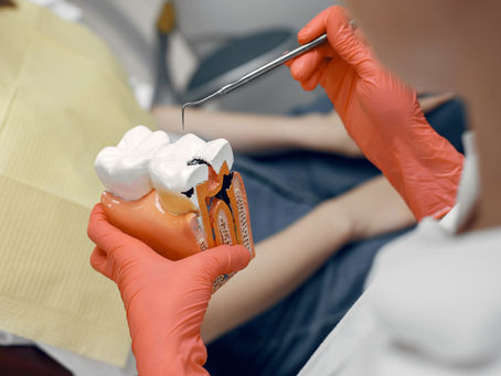 Coberturas tratamientos de endodoncia en Málaga