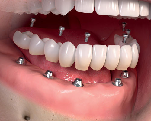 Prótese protocolo sob implantes @clinicagoud