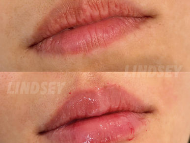 波士顿玻尿酸丰唇:Juvederm与Restylane唇部塑形详解