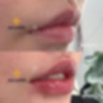 波士顿丰唇：爱丽医美玻尿酸案例
