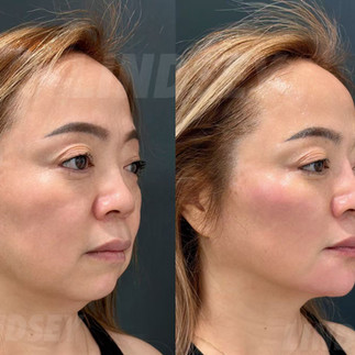 波士顿玻尿酸乔雅登 Juvederm 面部年轻化