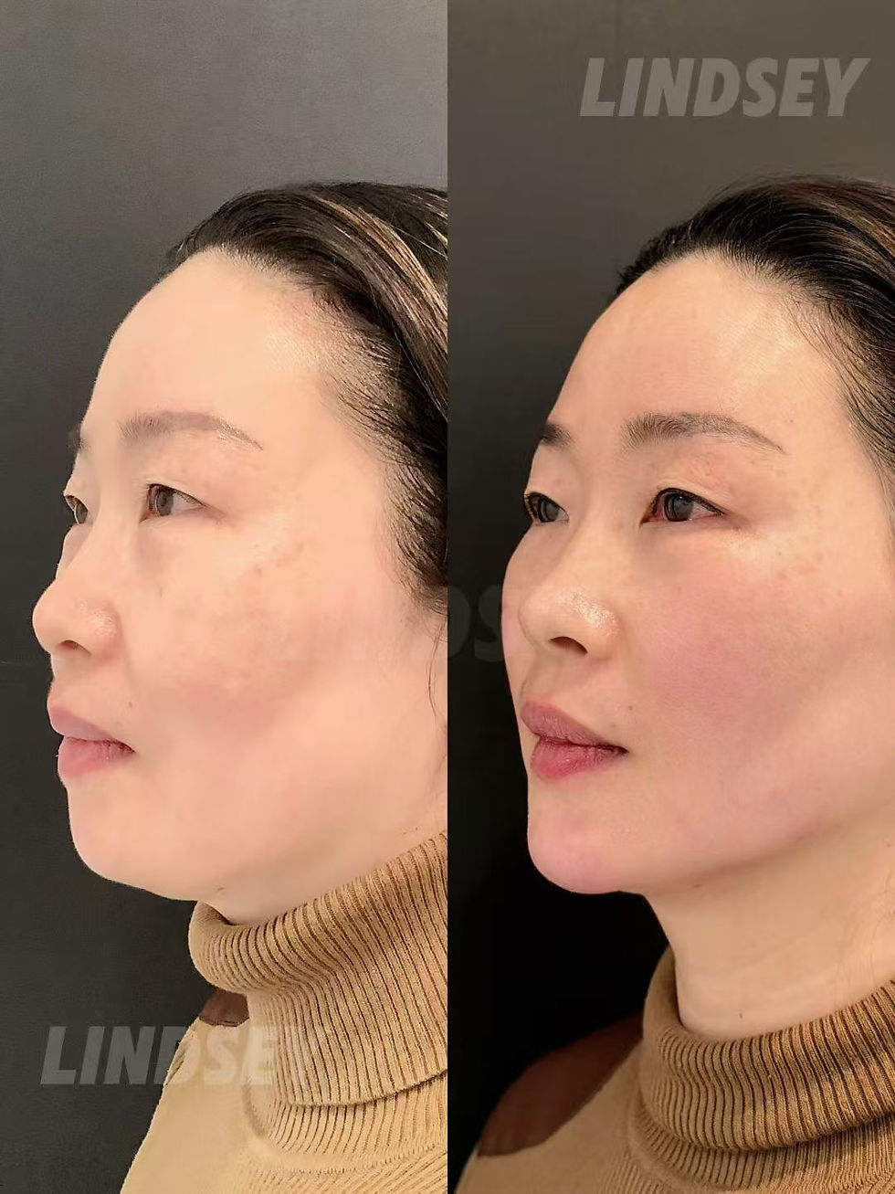 Boston Anti-Aging Guide: Filler facial balancing before and after