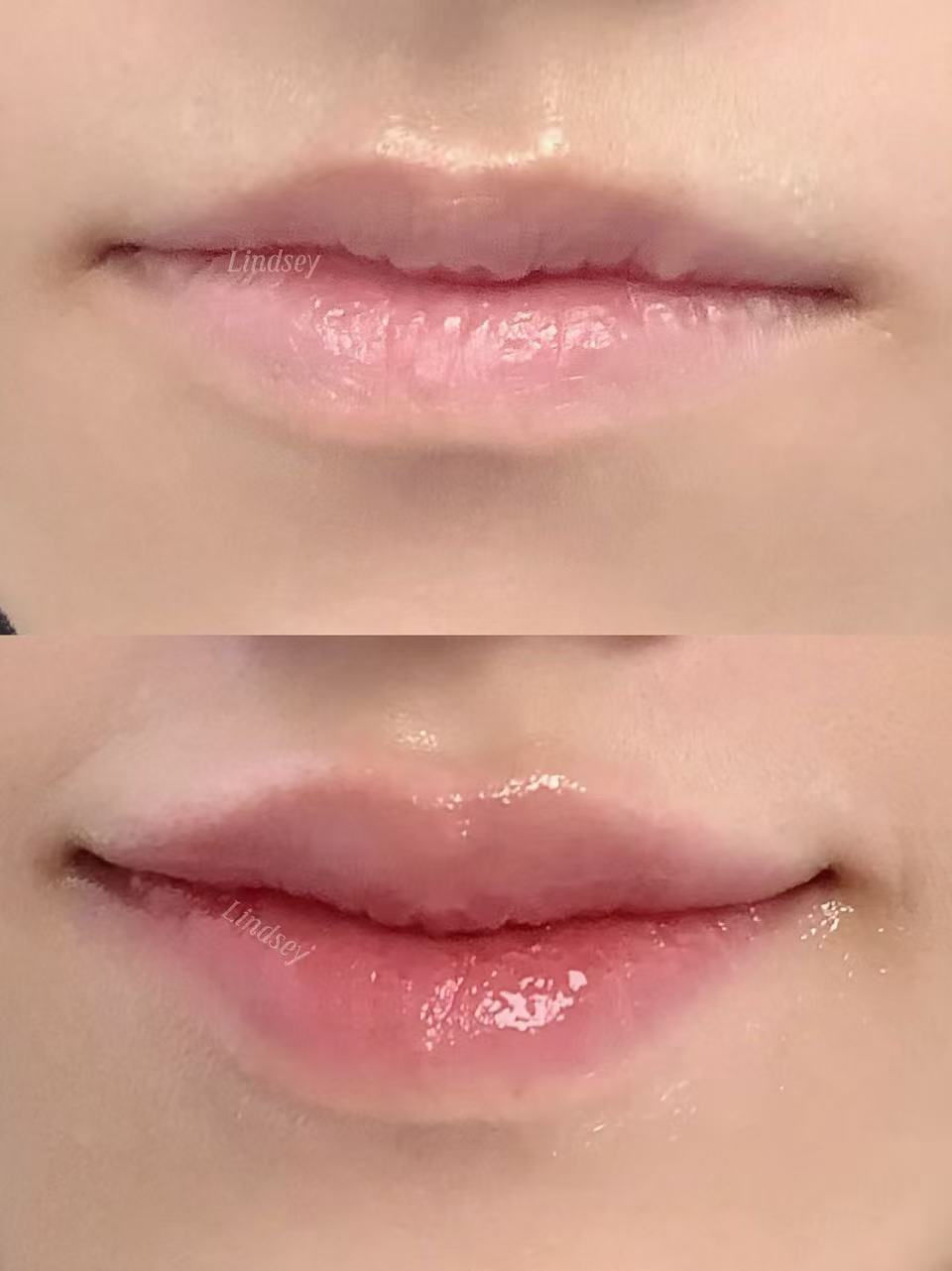 波士顿玻尿酸丰唇案例