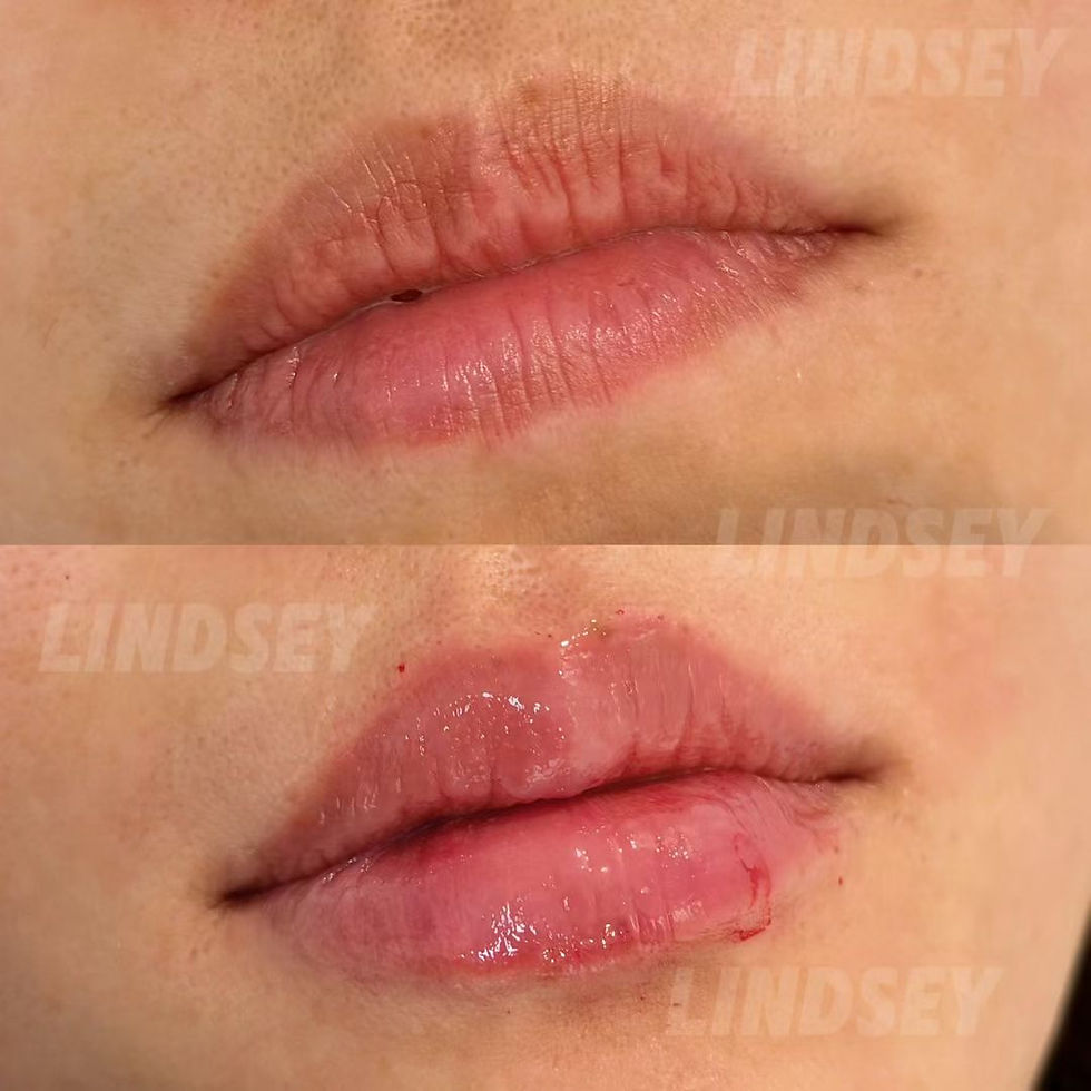 Boston lip filler before and after Juvederm natural results