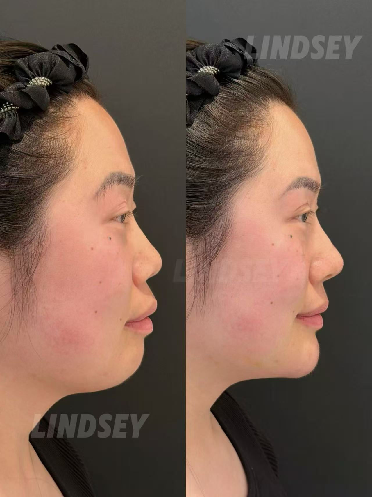波士顿玻尿酸乔雅登 Juvederm 面部年轻化