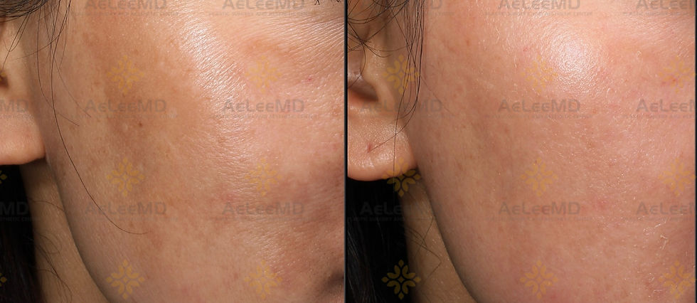 Melasma Treatment at AeLeeMD Laser Center in Boston