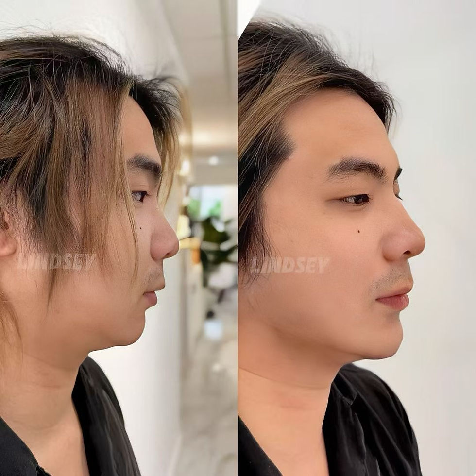 波士顿下巴填充案例(男性T区综合调整)