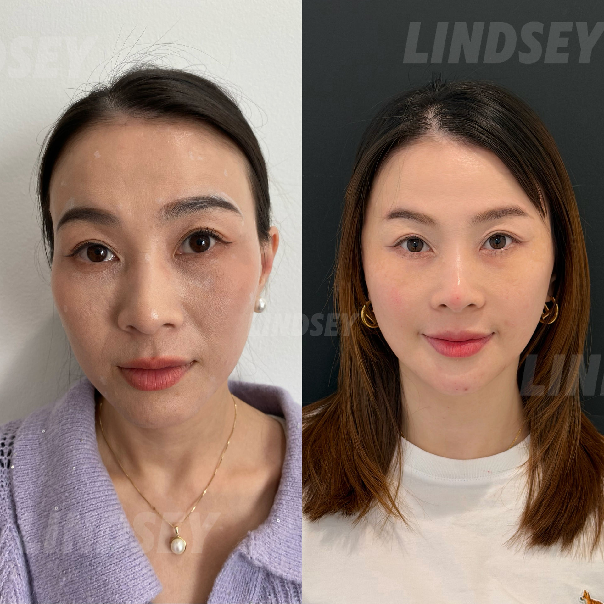 波士顿玻尿酸乔雅登 Juvederm 面部年轻化