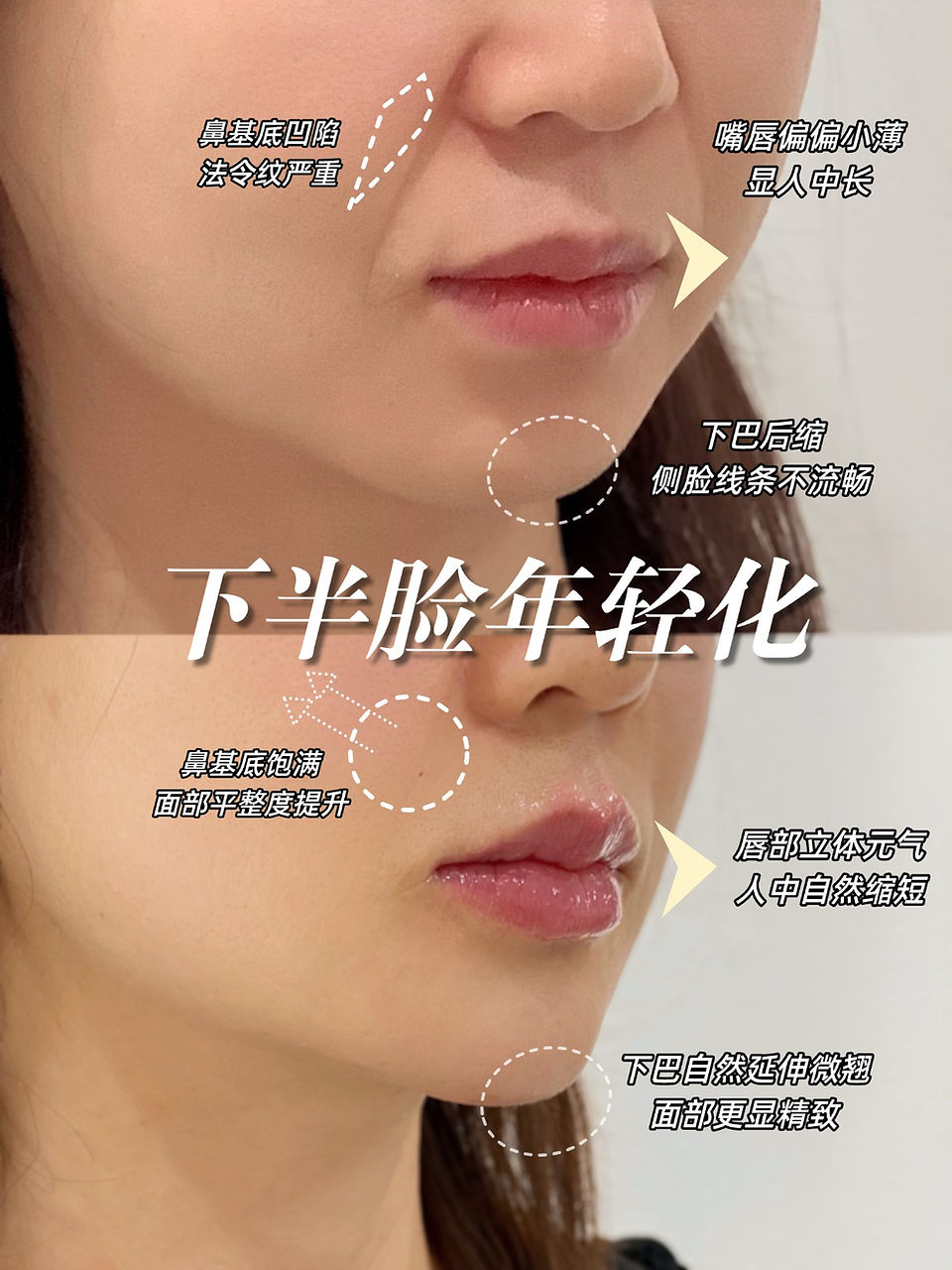 波士顿玻尿酸乔雅登 Juvederm 面部年轻化