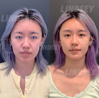 Before and after Asian facial rejuvenation treatment showing enhanced jawline definition, facial balancing, improved skin quality, and natural anti-aging results.