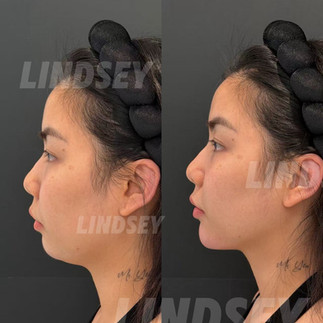 波士顿玻尿酸乔雅登 Juvederm 面部年轻化