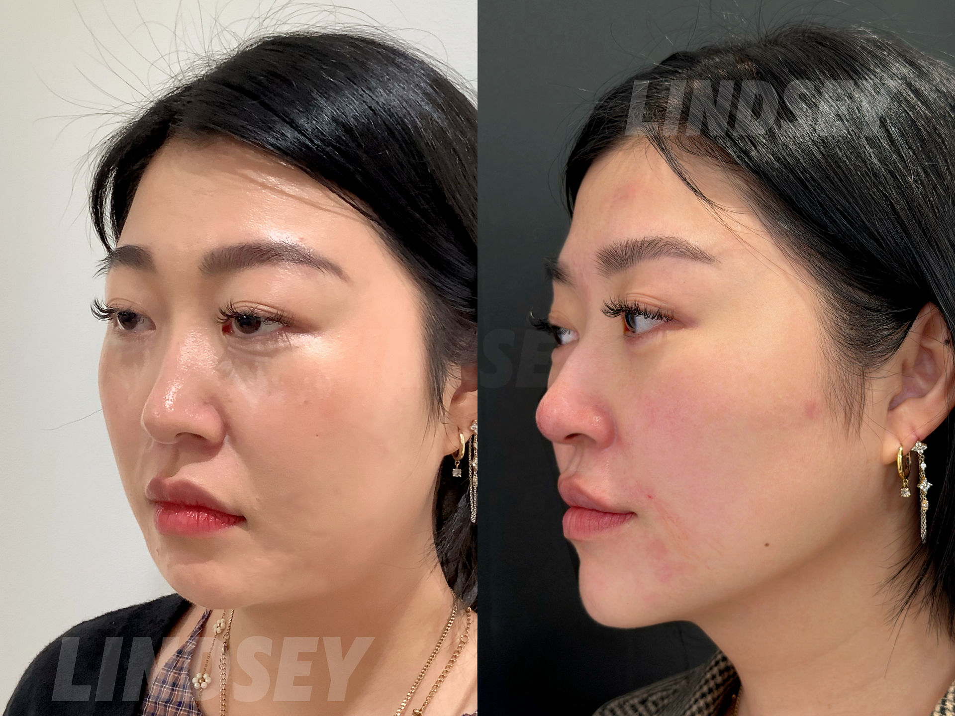 波士顿玻尿酸乔雅登 Juvederm 面部年轻化