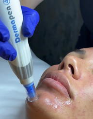 Skin Needling