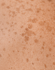 Pigmentation