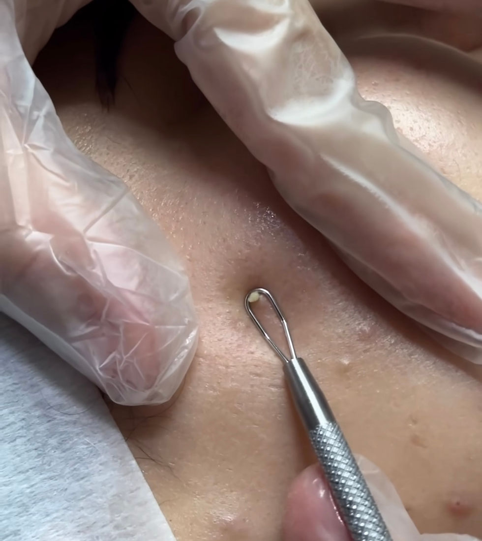 Extractions