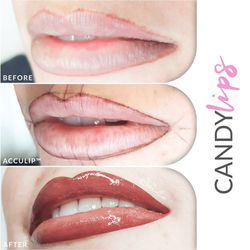 Τατουάζ Χελιών | Dermacraft