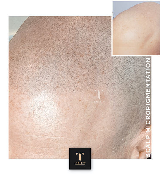 tatouaz mallion prin kai meta | athina | Trico