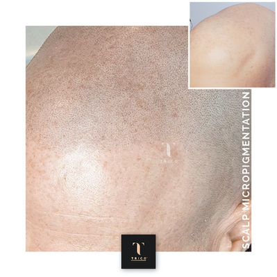 Before: shaved head showing scalp shine and hair loss pattern. After: SMP result with a clean hairline and even coverage on the scalp.