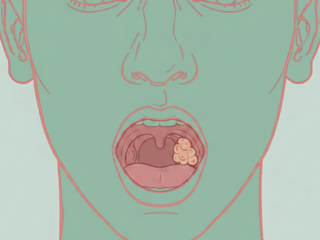 Câncer de faringe (orofaringe), HPV e os sinais que merecem atenção