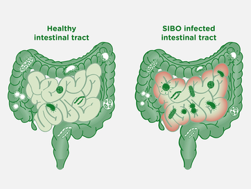 Intestin irritable : et si c'était un SIBO ?