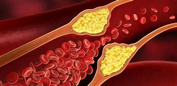 Sblocca le arterie e vivi più a lungo