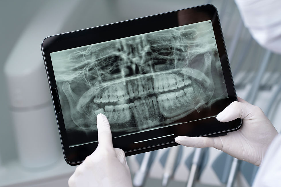 Case Study: Why Wisdom Teeth Should Not Always Wait