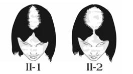 Women hairloss Type 2