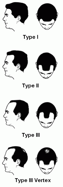 Norwood Scale Type 1-3