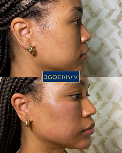 360 Derma PRP Facial Balancing